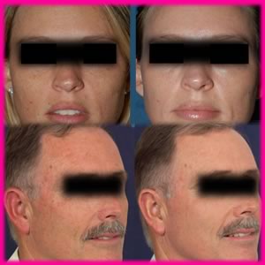 Fraxel Laser